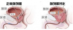 许昌治疗前列腺钙化哪家医院好？