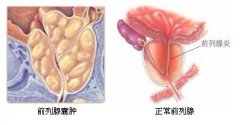 许昌治疗前列腺囊肿多少钱？